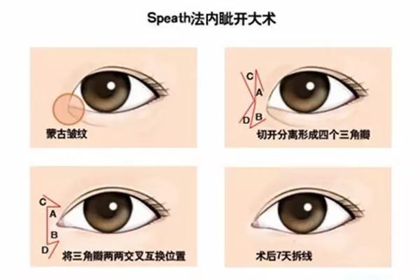 眼角成型